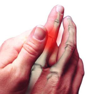 Arthritis of the fingers: treatment, causes, symptoms