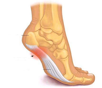 Treatment of calcaneal spur shock-wave therapy: reviews. Treating the calcaneal spur folk remedies and medical preparations