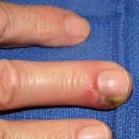 On the finger of the panaritium. Treatment at home is possible?