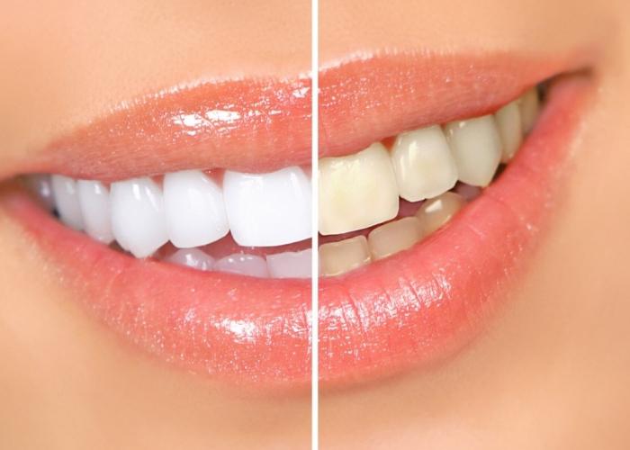 An unusual way to use hydrogen peroxide: teeth whitening