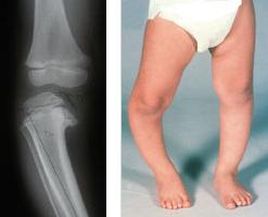 Symptoms of rickets in infants. Prevention