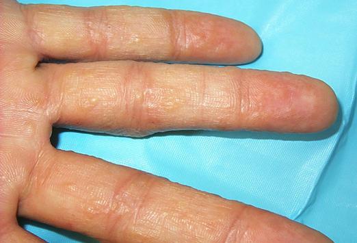Watery vesicles on the fingers: symptomatology and treatment